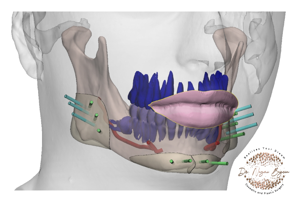 3d chin and jaw implants with soft tissue coverage for natural facial harmony in dubai