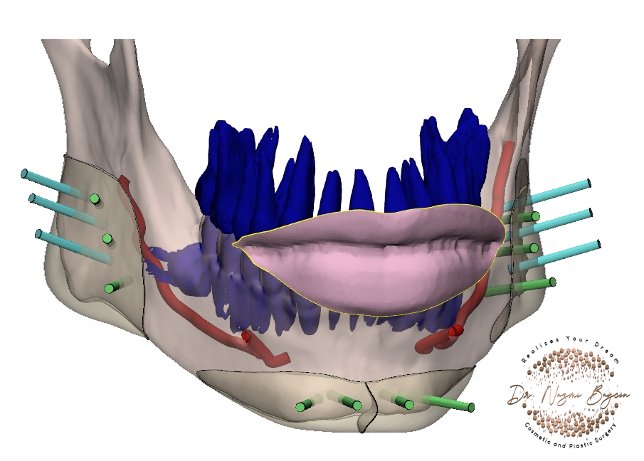 3d customized chin and jaw implants in dubai