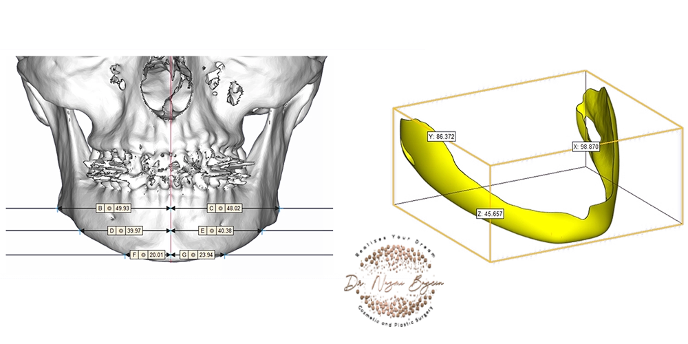 3d facial bone imaging and jawline implant design in dubai