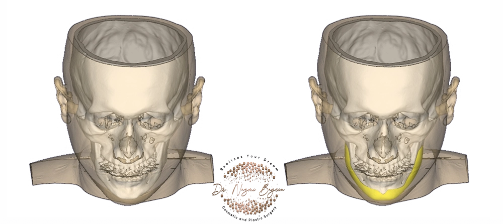 front view of the jawline implant on the 3d facial bone imaging in dubai