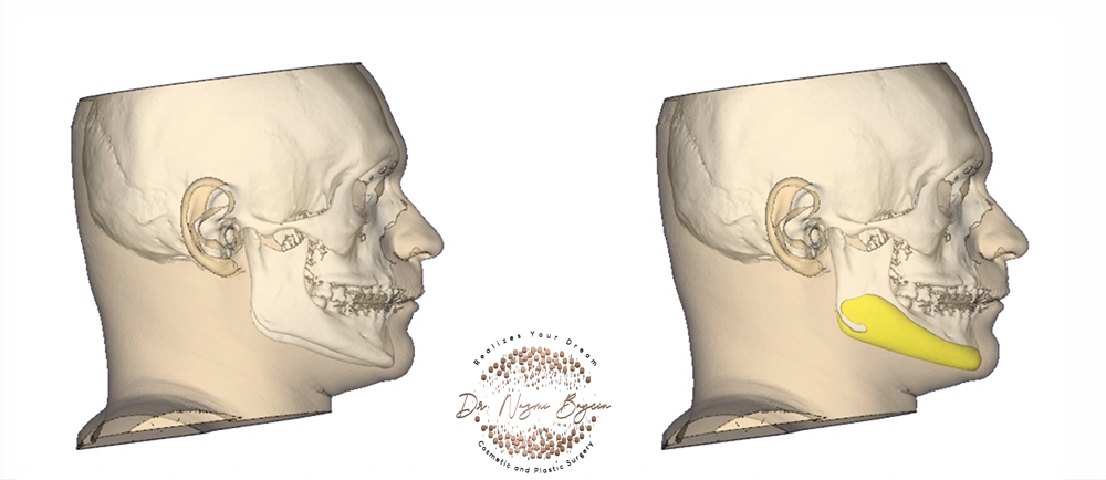 side view of the jawline implant on the 3d facial bone imaging in dubai