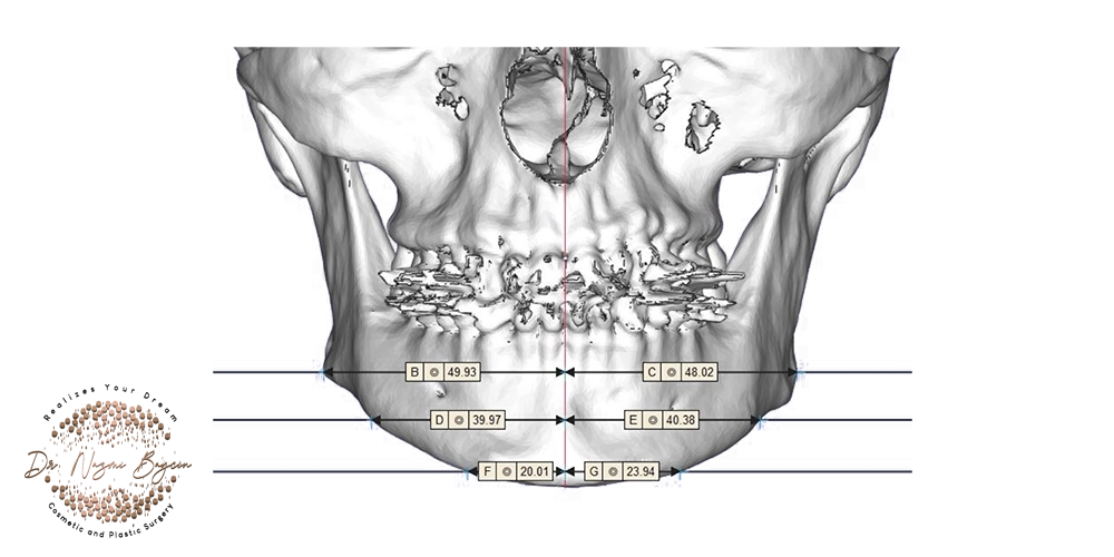 3d facial bone metrics for implant design in dubai