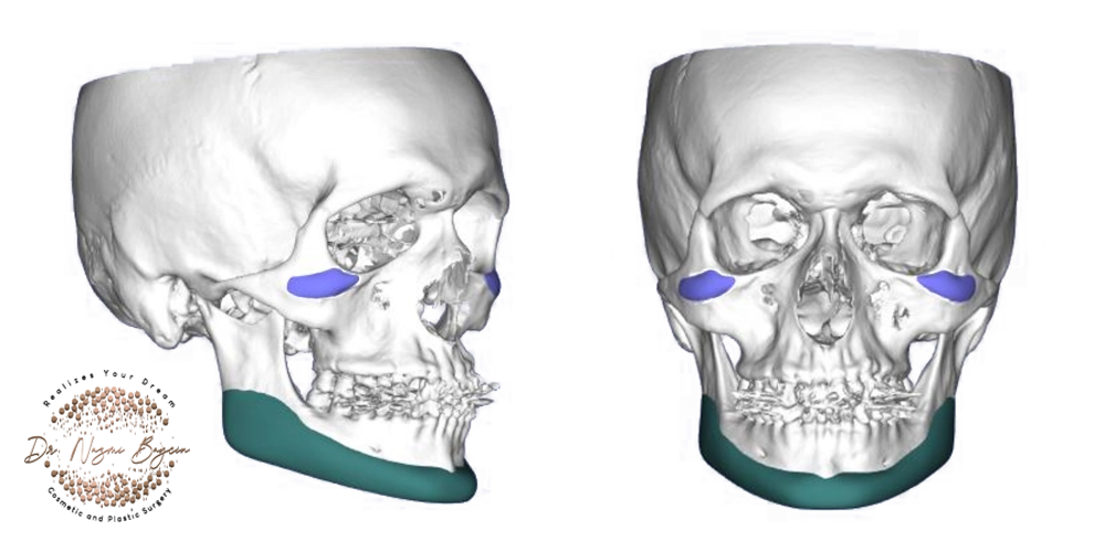facial bone implant design on 3d ct scan in dubai