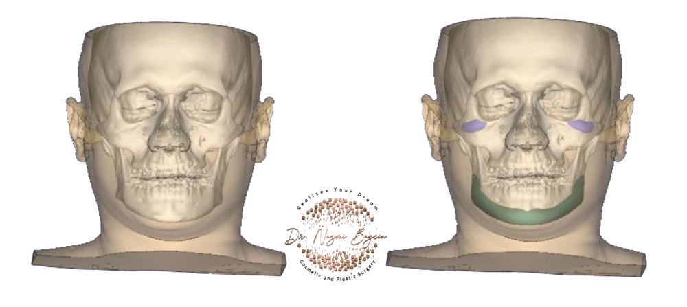 3D visualization comparing native facial bone with custom-designed jawline and malar (cheekbone) implants for precision augmentation in Dubai, showing how the patient-specific implants are digitally contoured to lock onto the individual's own bone topography with feathered, seamless margins along the jawline and cheekbones