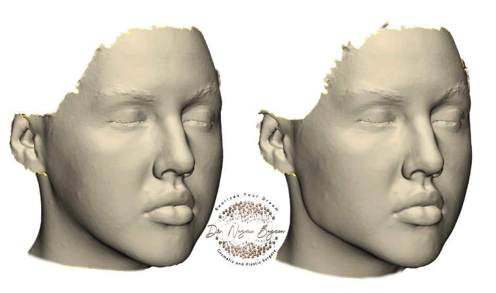 3D facial scan comparison showing current facial contour on the left versus simulated jawline definition after custom chin and mandibular implant planning by Dr. Nazmi Baycin in Dubai
