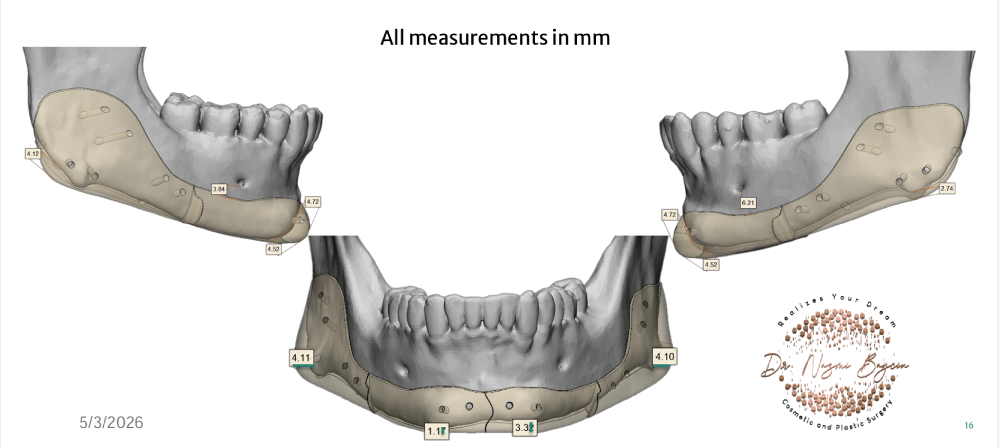 Simulation of left, right, and front views after custom chin and jaw implant fixation in Dubai