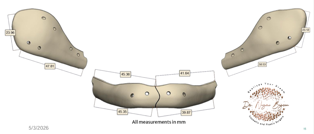 Four 3D printed PEEK chin and jaw implants with sub-millimeter measurements for total jawline harmony in Dubai
