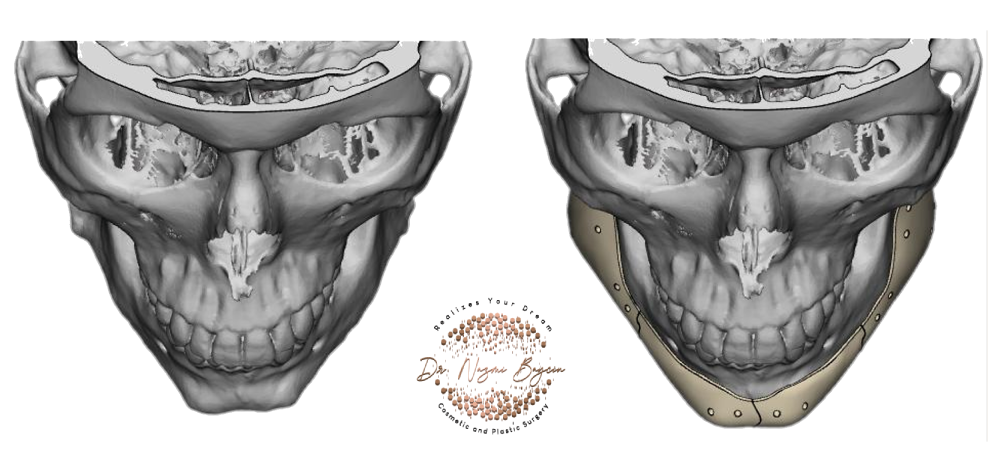 Top view 3D skull scan comparing no implant left side versus custom implant right side for jaw augmentation in Dubai