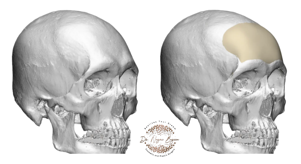 3D skull imaging and forehead implant design in Dubai, showing how the frontal bone, brow ridges and temples are analyzed in three dimensions so the implant follows the natural contour of the skull for a precise fit and predictable projection
