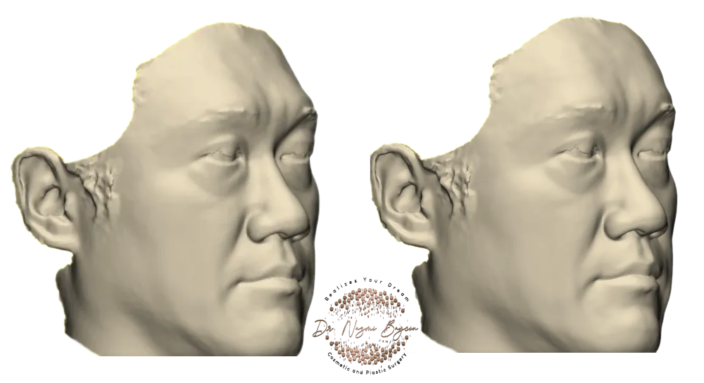 Side view of the forehead implant on 3D before & after simulation in Dubai, showing the bespoke frontal bone implant so the slope of the forehead and the brow ridge transition can be planned precisely